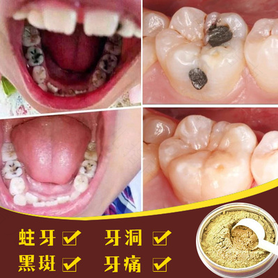 儿童蛀牙疼怎么办教你立刻止疼 儿童蛀牙疼怎么办教你立刻止疼