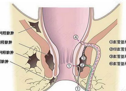 肛有问题会出现哪些症状 肛有问题会出现哪些症状
