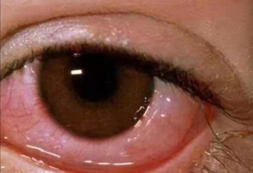 双眼皮结膜水肿要多久恢复期 双眼皮结膜水肿要多久恢复期