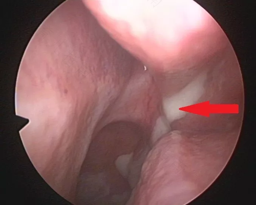 鼻窦炎该怎么治疗最好 鼻窦炎该怎么治疗最好