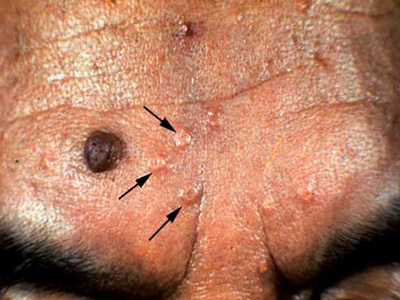 感染尖锐疣是不是感染了hpv 感染尖锐疣是不是感染了hpv