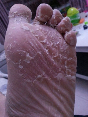 脚上有脚气脱皮怎么办 脚上有脚气脱皮怎么办