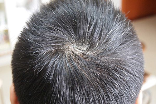 30岁长白发怎么治疗 30岁长白发怎么治疗