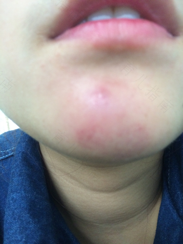 下巴周围长小疙瘩是什么原因 下巴周围长小疙瘩是什么原因