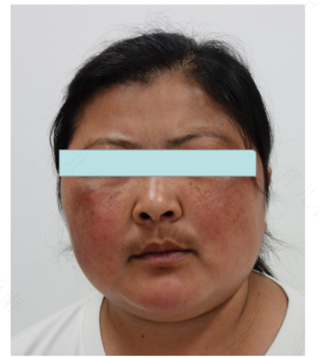 满月脸怎么快速瘦下来 满月脸怎么快速瘦下来