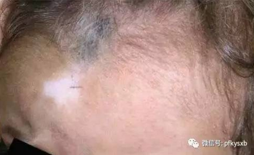 贫血会导致皮肤干燥吗 贫血会导致皮肤干燥吗