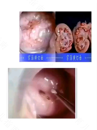 宫颈纳囊是什么意思啊?