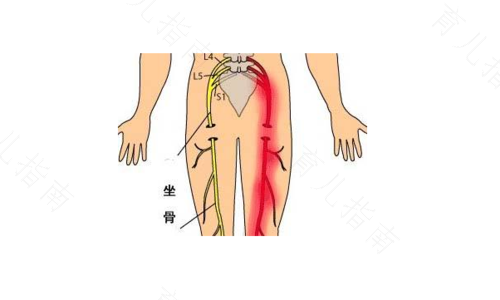 左半个屁股酸疼怎么回事 左半个屁股酸疼怎么回事