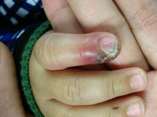 指甲残留在肉里怎么办 指甲残留在肉里怎么办