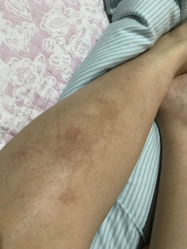 身上发痒怎么办小妙招 身上发痒怎么办小妙招