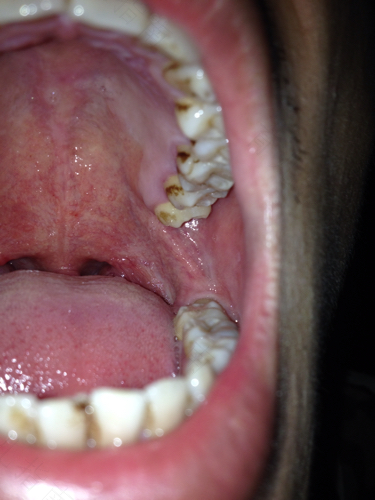 感染艾滋病窗口期有什么症状 感染艾滋病窗口期有什么症状