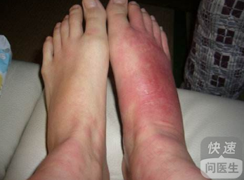 风湿腿肿了怎么消肿中药 风湿腿肿了怎么消肿中药