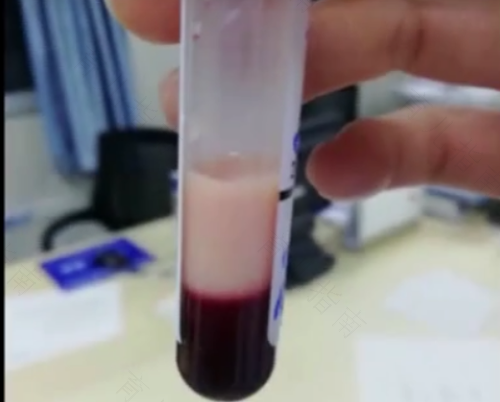 化验血能不能吃饭喝水 化验血能不能吃饭喝水