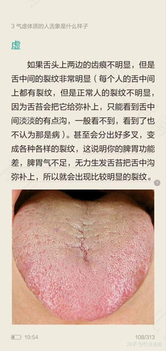 舌苔一天就很厚怎么办 舌苔一天就很厚怎么办