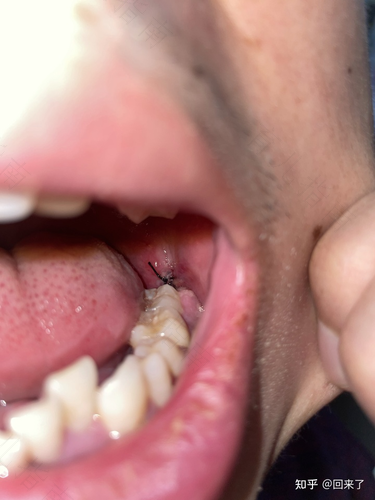 干槽症第几天出现症状 干槽症第几天出现症状