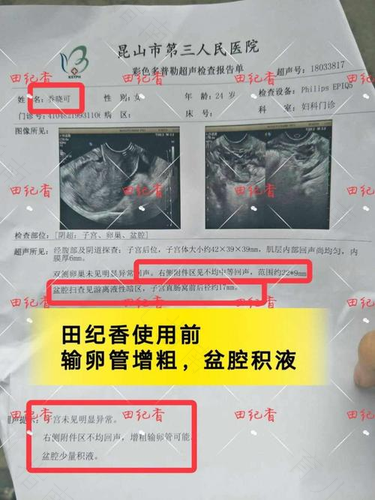 输卵管远端扭曲增粗 输卵管远端扭曲增粗