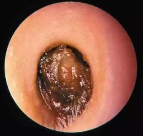 耳朵被耳屎堵了怎么办