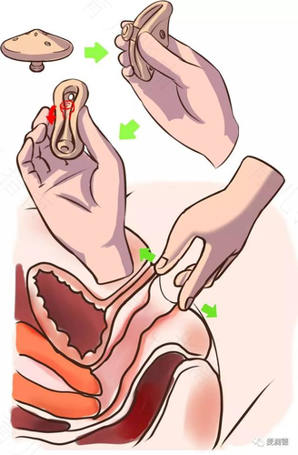 子宫托的作用 子宫托的作用