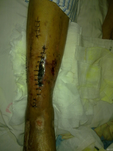 小腿骨折手术后多久能消肿 小腿骨折手术后多久能消肿