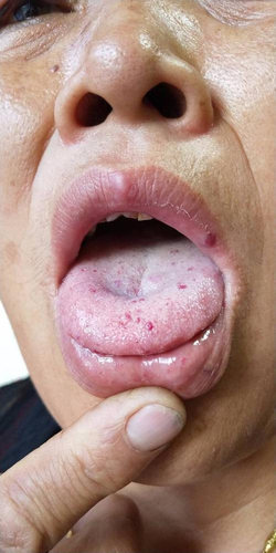 婴儿舌苔有红点怎么回事 婴儿舌苔有红点怎么回事