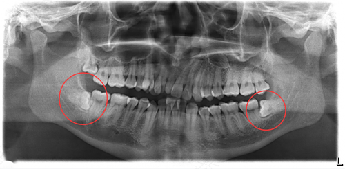 拔智齿为什么要缝线