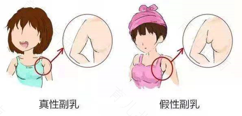副乳可以切除吗 副乳可以切除吗