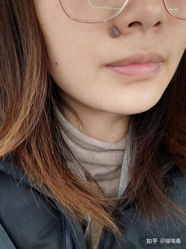 鼻翼上长痣可以去掉吗 鼻翼上长痣可以去掉吗