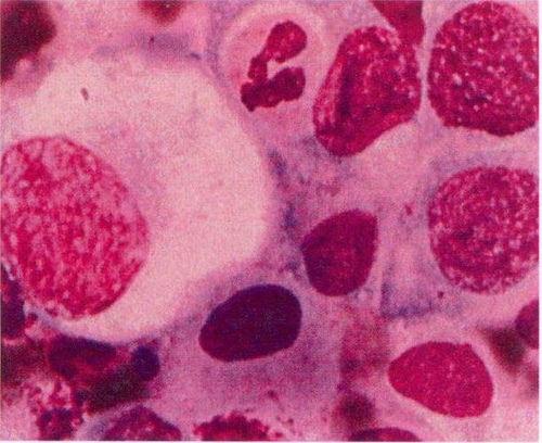 宫颈炎lsil严重吗 宫颈炎lsil严重吗