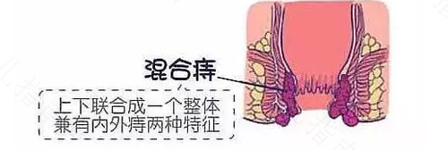 做完痔疮手术后水肿怎么办 做完痔疮手术后水肿怎么办