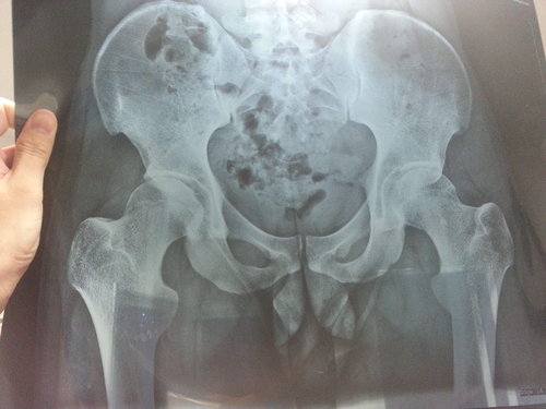 走路右边胯骨疼是怎么回事