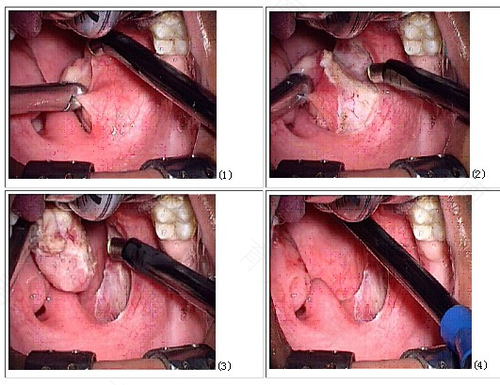 慢性咽喉炎的症状有哪些表现 慢性咽喉炎的症状有哪些表现