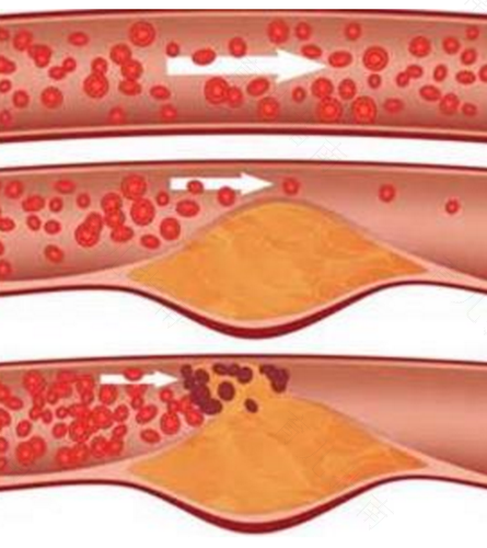 颈动脉粥状动脉硬化怎么办 颈动脉粥状动脉硬化怎么办