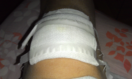 膝盖肿了怎么快速消肿止痛 膝盖肿了怎么快速消肿止痛