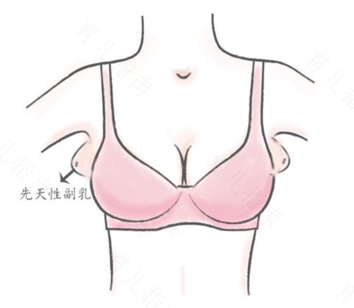 十几岁就有副乳