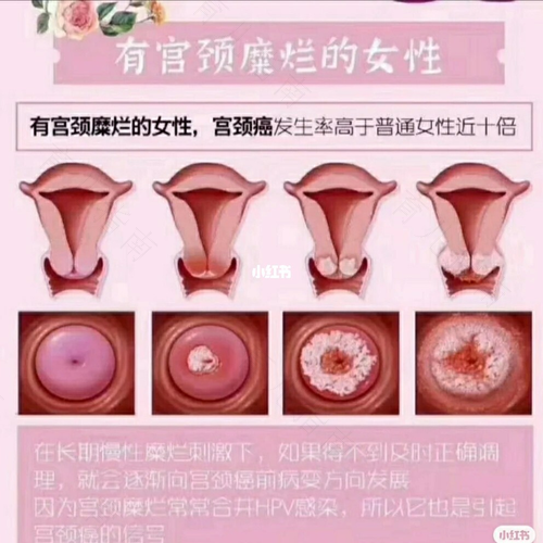 中度宫颈糜烂会接触性出血吗 中度宫颈糜烂会接触性出血吗