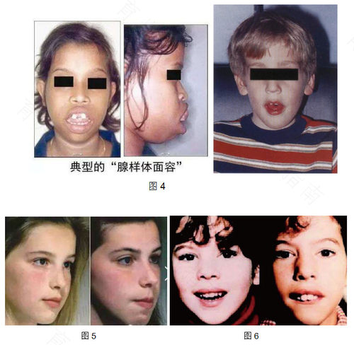 鼻腺体肥大症状图片 鼻腺体肥大症状图片