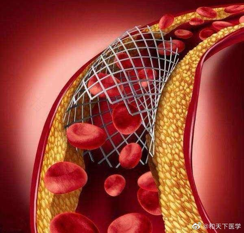 冠心病该怎么治疗最好 冠心病该怎么治疗最好
