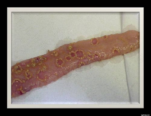 坏死性肠炎的症状为 坏死性肠炎的症状为