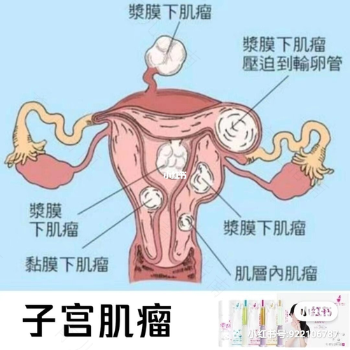 子宫肌瘤痛怎么办快速止痛 子宫肌瘤痛怎么办快速止痛