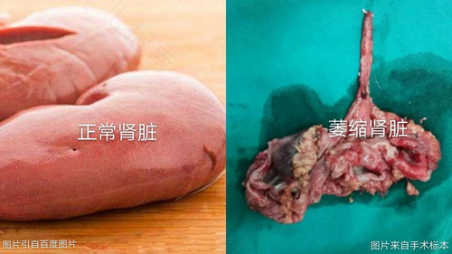 肾积水发烧了怎么办 肾积水发烧了怎么办