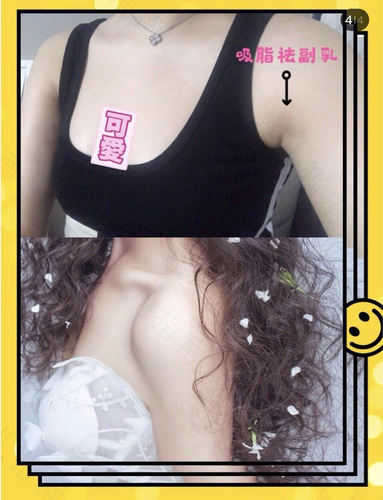 副乳能锻炼下去吗 副乳能锻炼下去吗