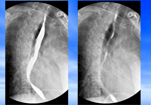 婴儿上消化道造影怎么做 婴儿上消化道造影怎么做