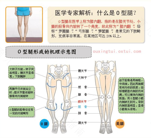 o型腿怎么纠正外旋