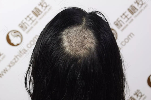 手术后疤痕颜色变黑怎么办 手术后疤痕颜色变黑怎么办