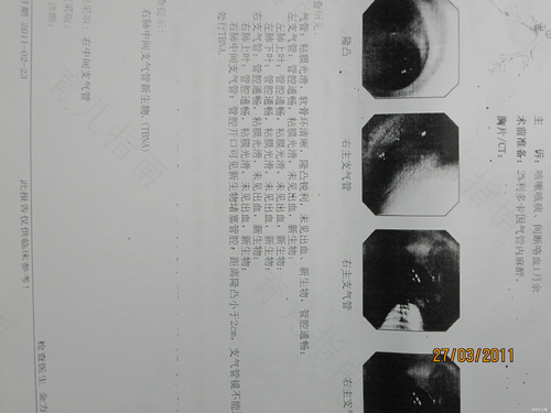 胸口疼咳嗽有血是怎么回事 胸口疼咳嗽有血是怎么回事