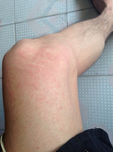 麻疹很痒怎么办 麻疹很痒怎么办