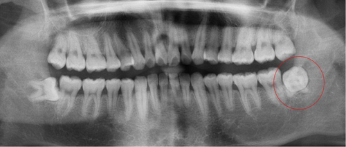 拔牙需要拍片吗? 拔牙需要拍片吗?