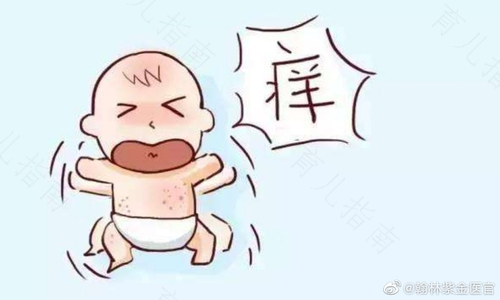 得了湿疹需要忌什么口 得了湿疹需要忌什么口