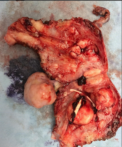 子宫里长囊肿有什么症状 子宫里长囊肿有什么症状