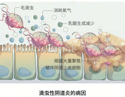蜂窝组织炎怎么样才不复发 蜂窝组织炎怎么样才不复发
